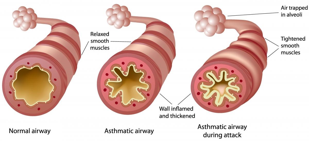 MA_asthma blog image 